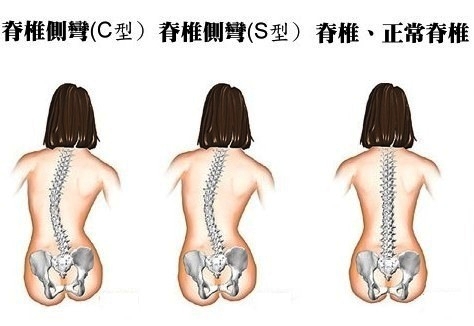 脊椎側彎